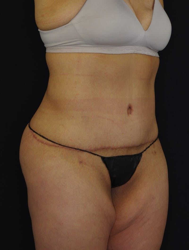 Liposuction Before & After Gallery - Patient 251562 - Image 2