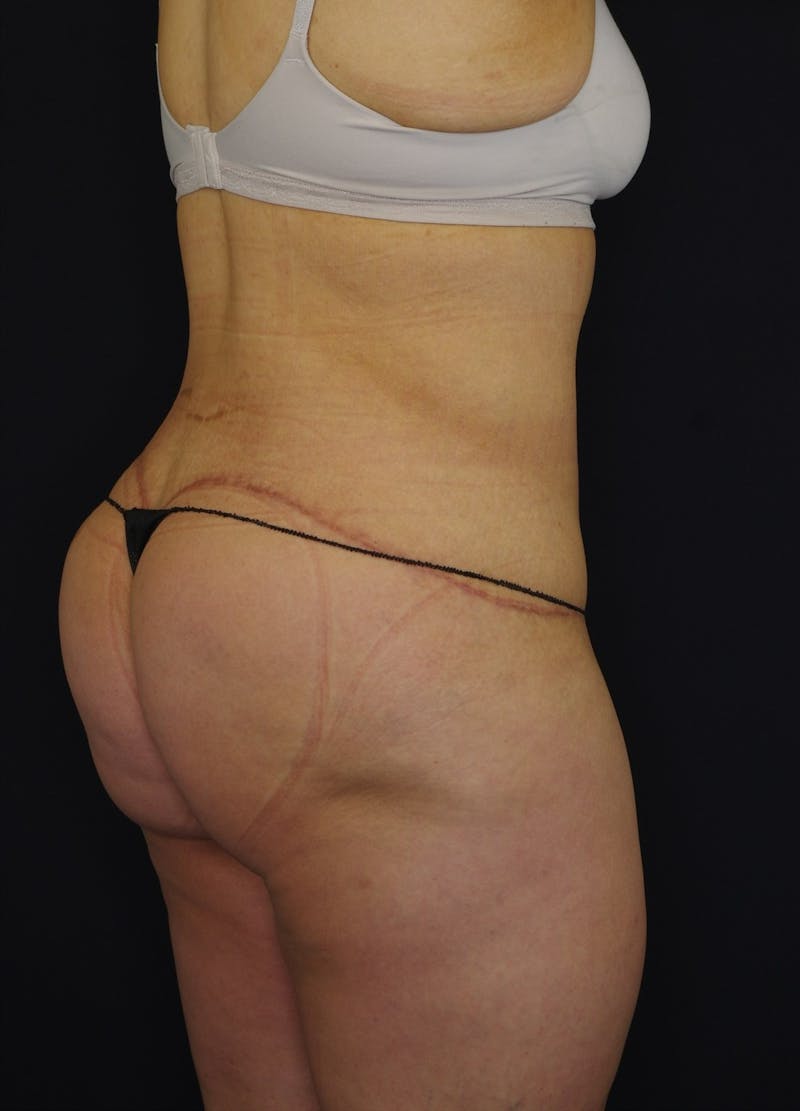 Liposuction Before & After Gallery - Patient 251562 - Image 4