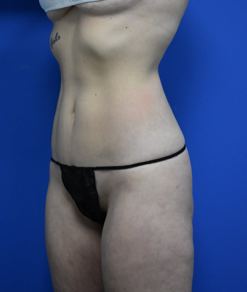 Liposuction Before & After Gallery - Patient 730296 - Image 4
