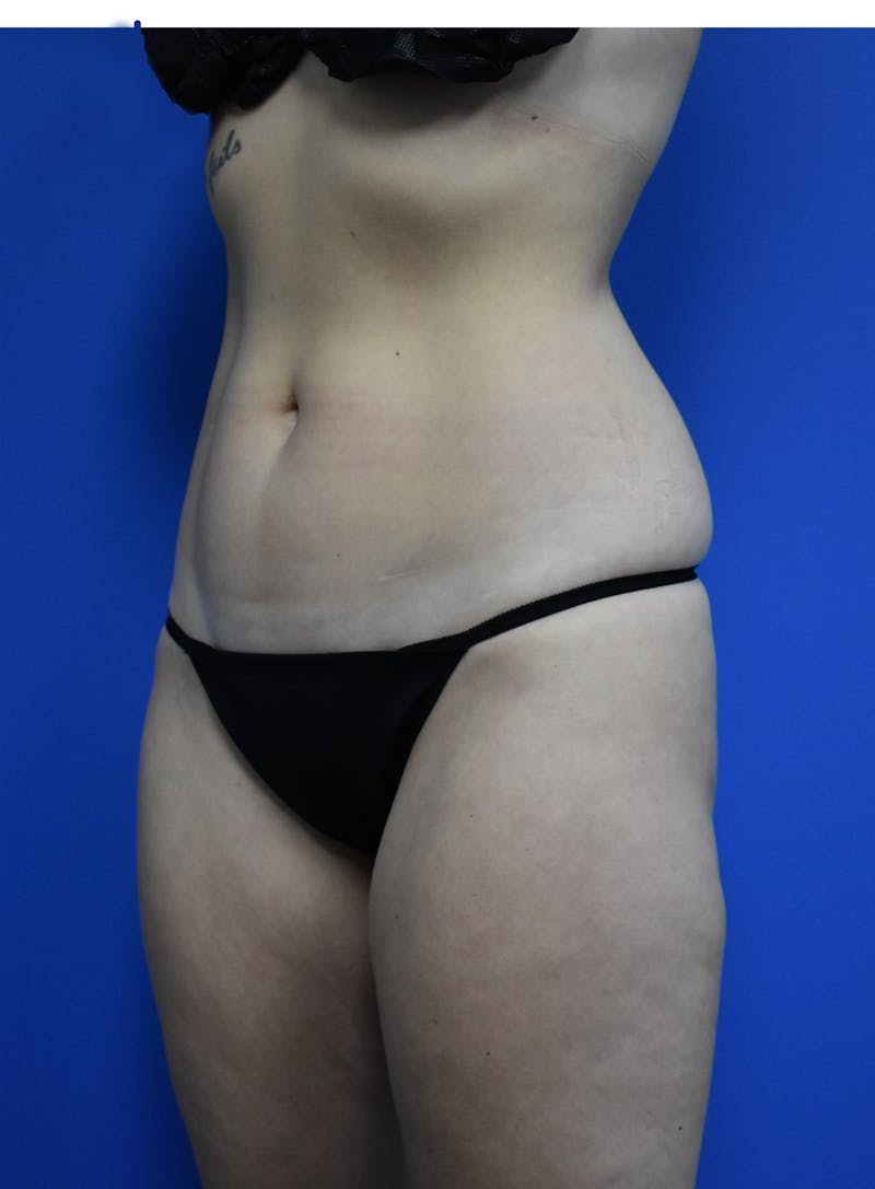Liposuction Before & After Gallery - Patient 730296 - Image 3