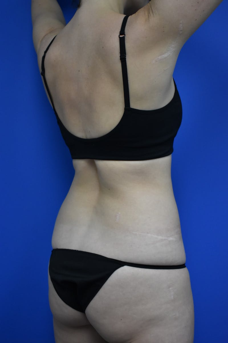 Liposuction Before & After Gallery - Patient 730296 - Image 9