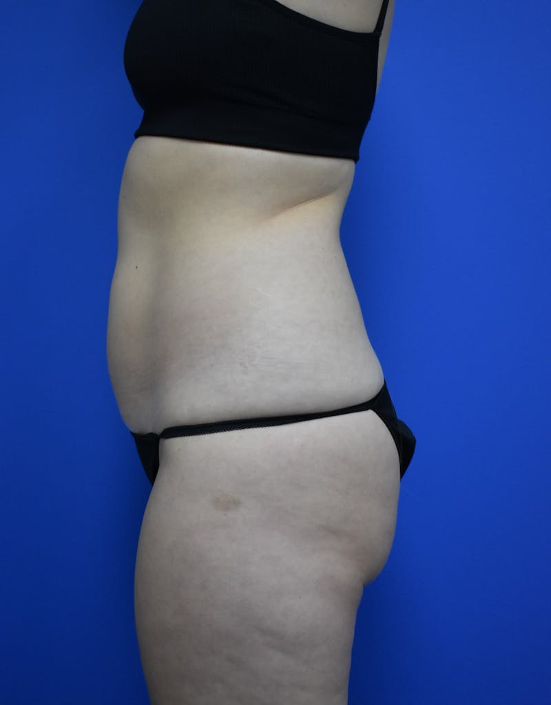 Liposuction Before & After Gallery - Patient 730296 - Image 5