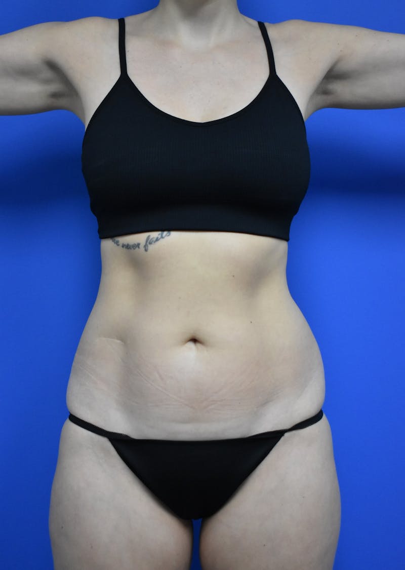 Liposuction Before & After Gallery - Patient 730296 - Image 11