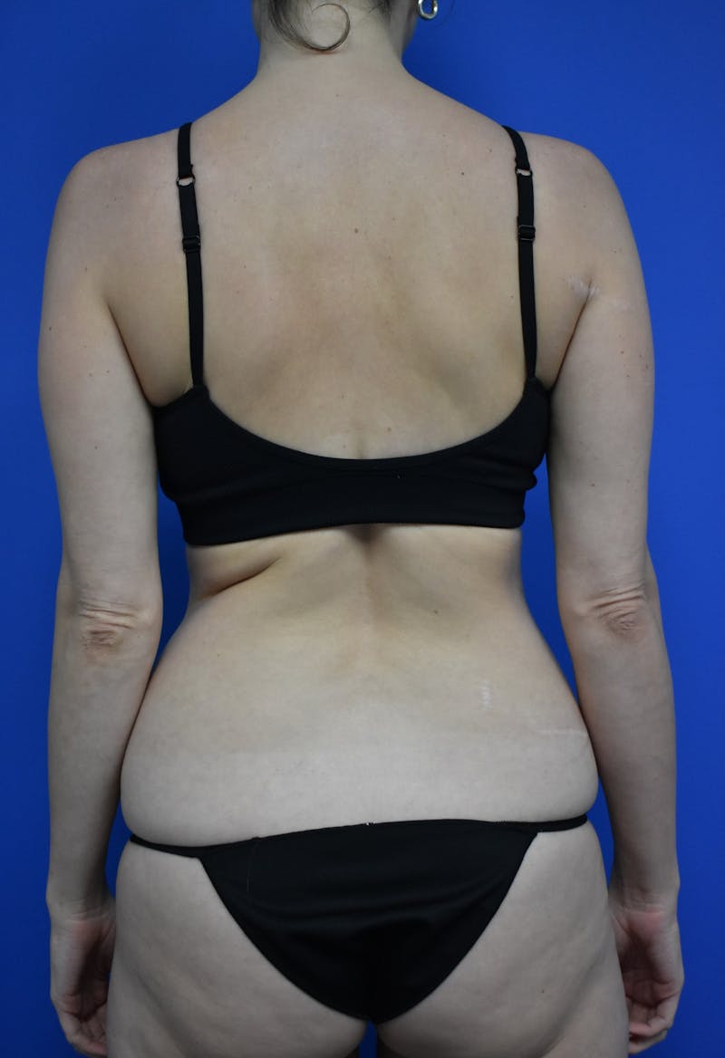 Liposuction Before & After Gallery - Patient 730296 - Image 1