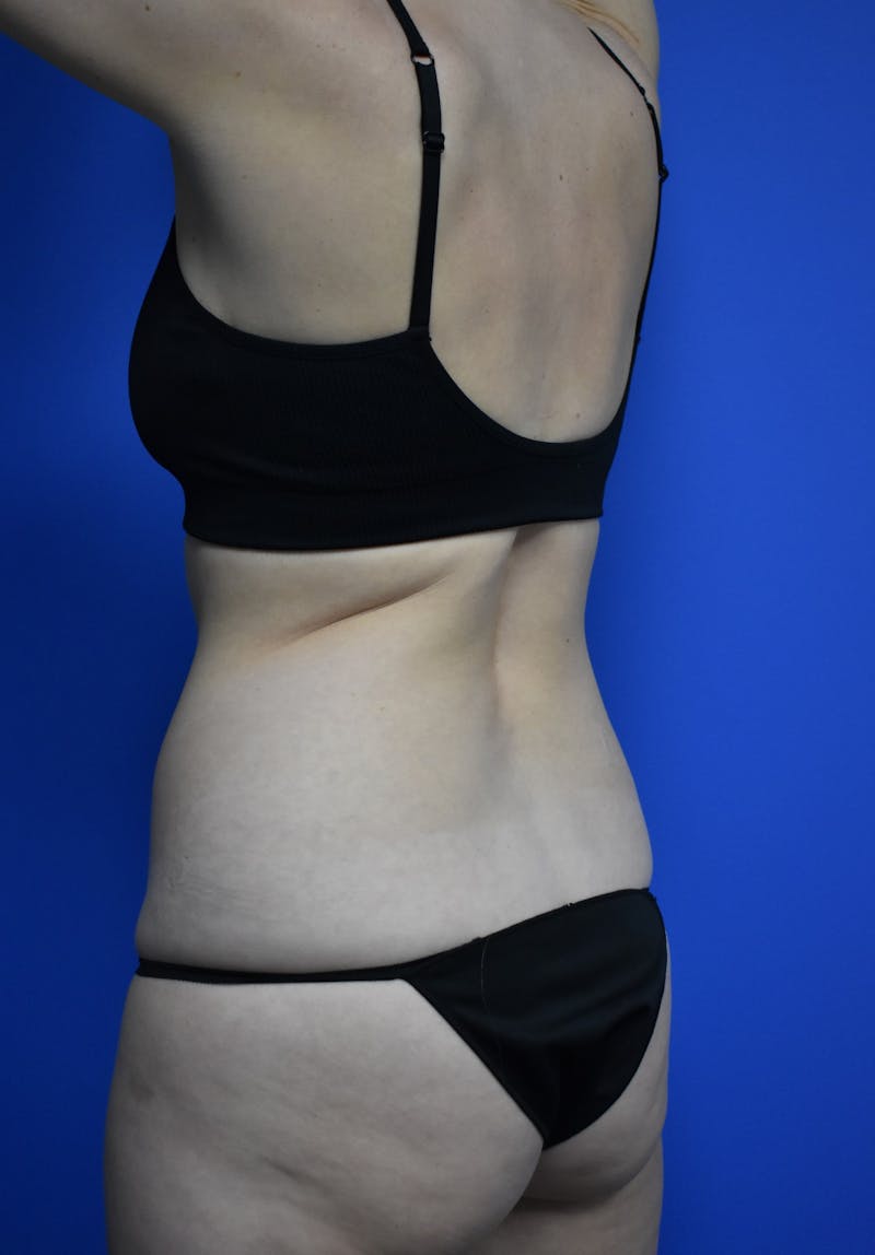 Liposuction Before & After Gallery - Patient 730296 - Image 7