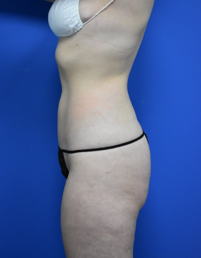Liposuction Before & After Gallery - Patient 730296 - Image 6