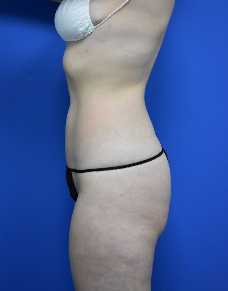 Liposuction Before & After Gallery - Patient 730296 - Image 6