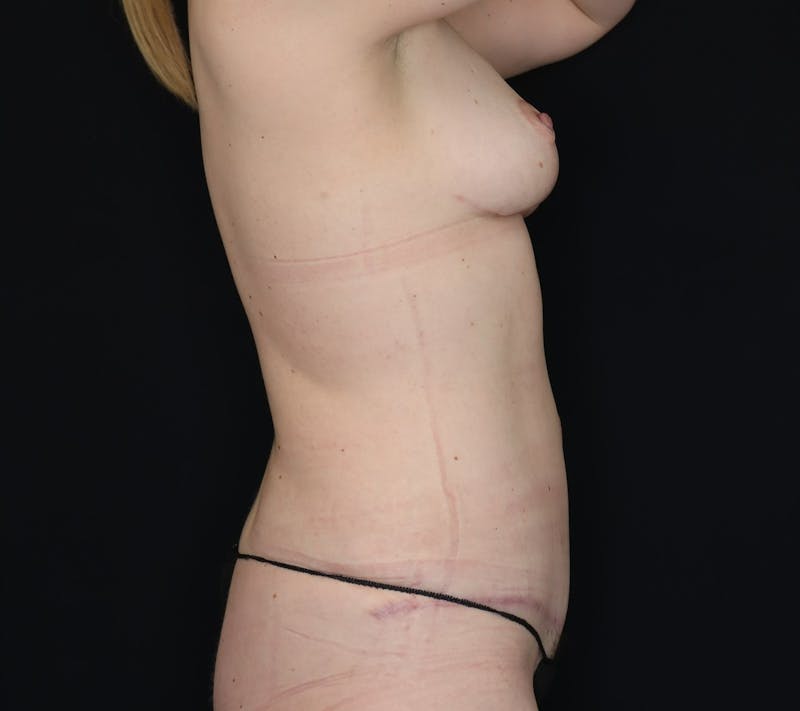 Abdominoplasty Before & After Gallery - Patient 156877 - Image 4