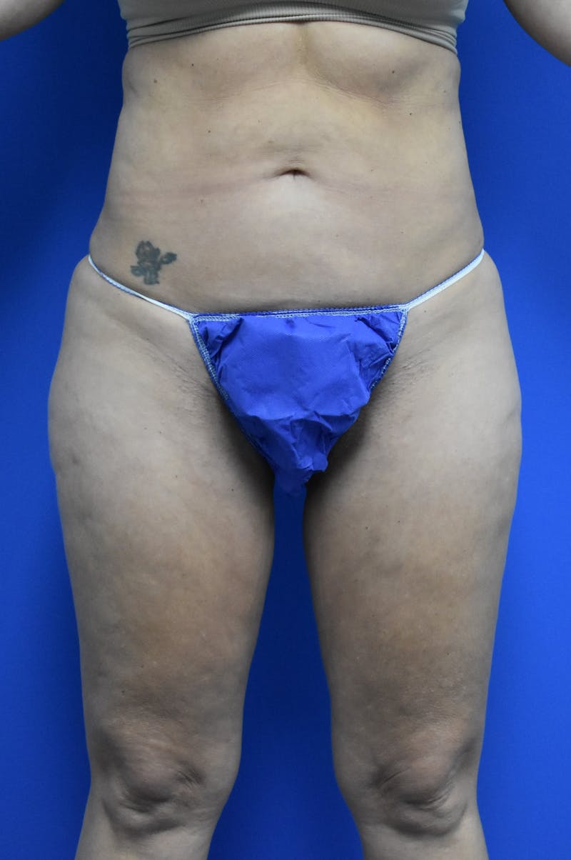 Liposuction Before & After Gallery - Patient 126755 - Image 1