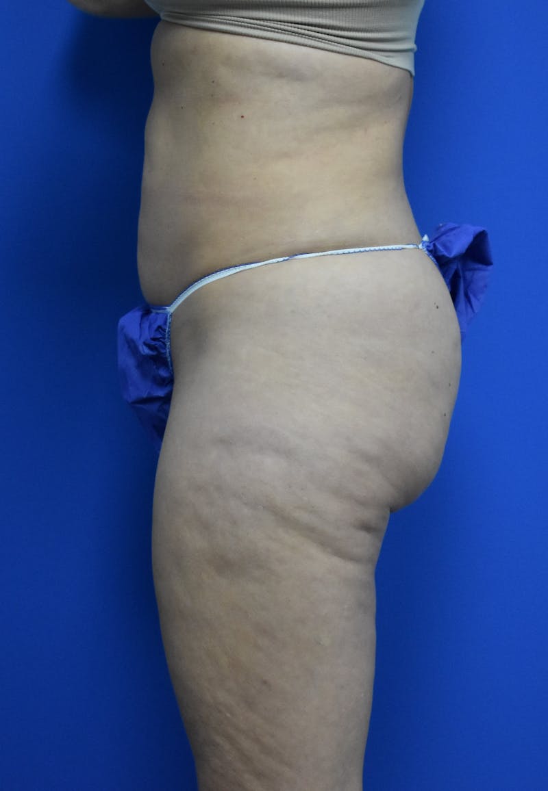 Liposuction Before & After Gallery - Patient 126755 - Image 3