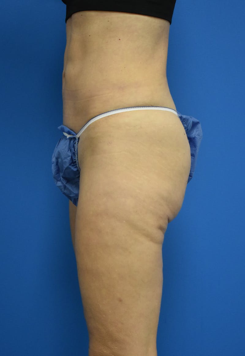 Liposuction Before & After Gallery - Patient 126755 - Image 4