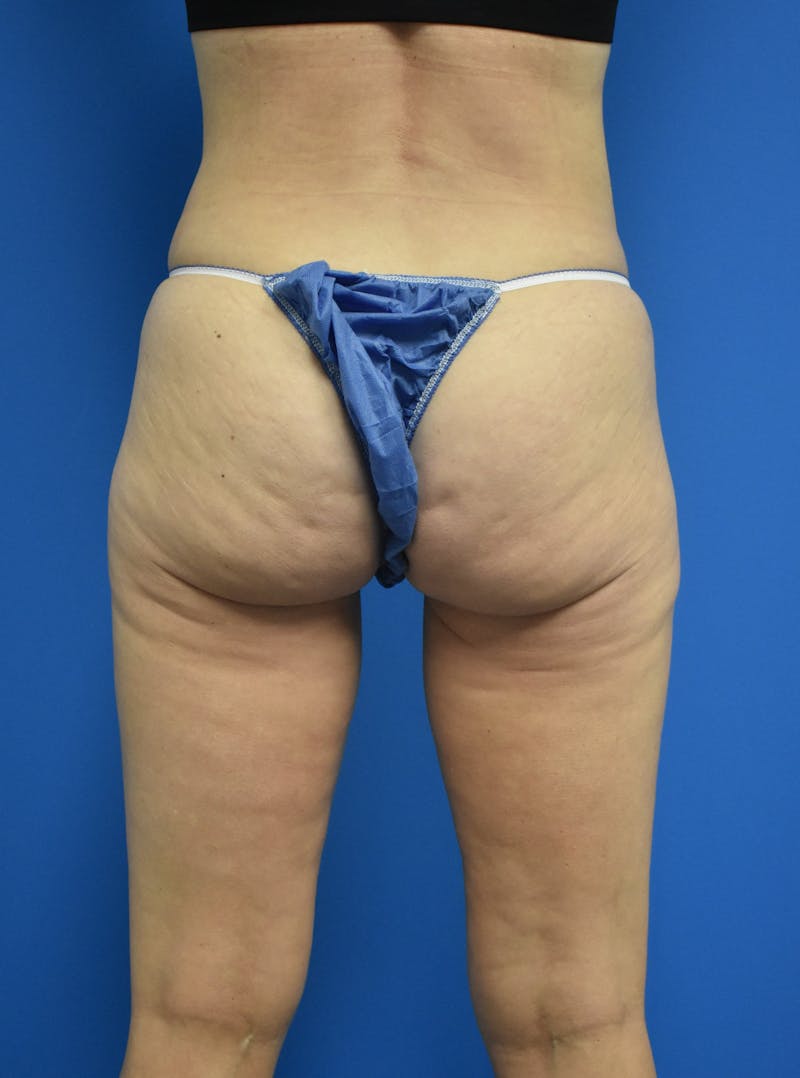 Liposuction Before & After Gallery - Patient 126755 - Image 6