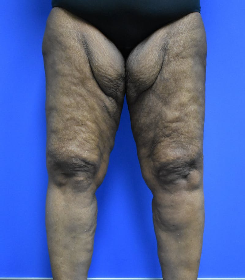 Thigh Lift Before & After Gallery - Patient 570754 - Image 1