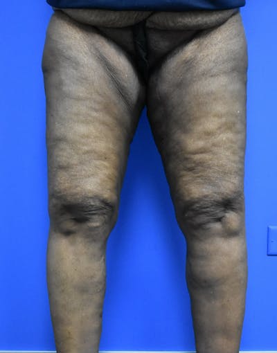 Thigh Lift Before & After Gallery - Patient 570754 - Image 2