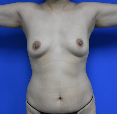 Breast Augmentation Before & After Gallery - Patient 113568 - Image 1
