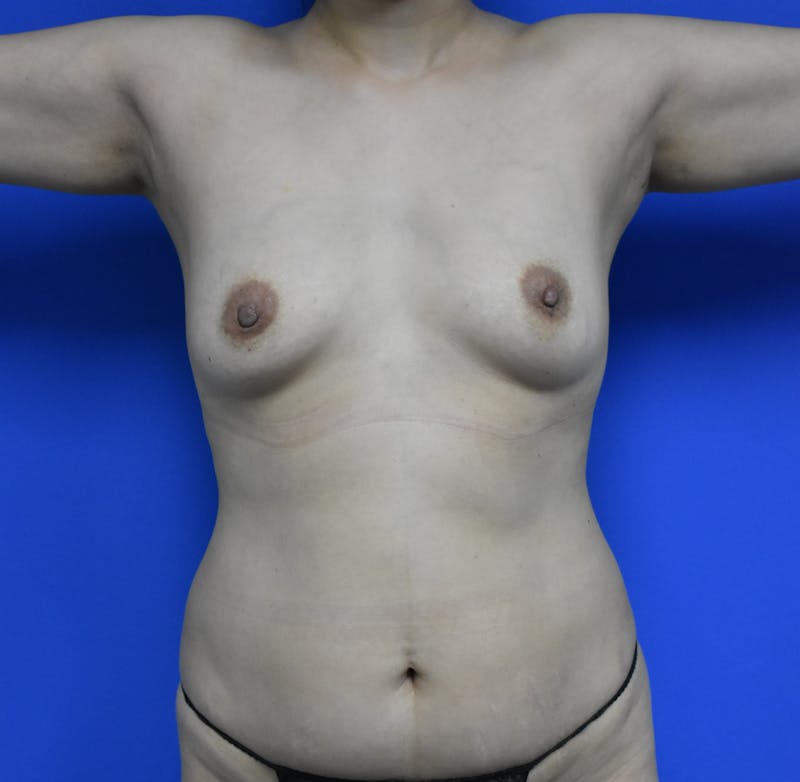 Liposuction Before & After Gallery - Patient 103294 - Image 7