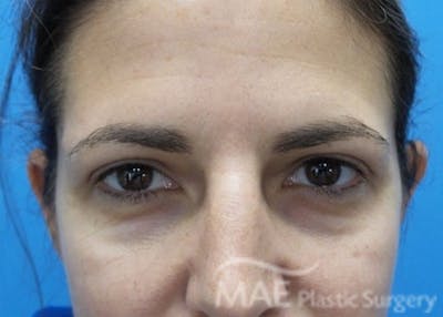 Eyelid Surgery Before & After Gallery - Patient 193463 - Image 2