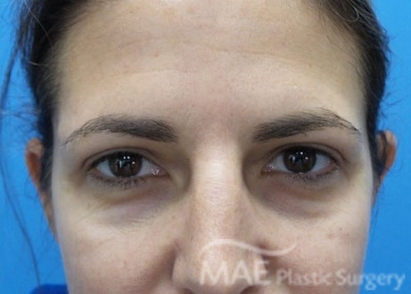 Eyelid Surgery Before & After Gallery - Patient 193463 - Image 2