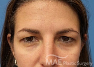 Eyelid Surgery Before & After Gallery - Patient 193463 - Image 1