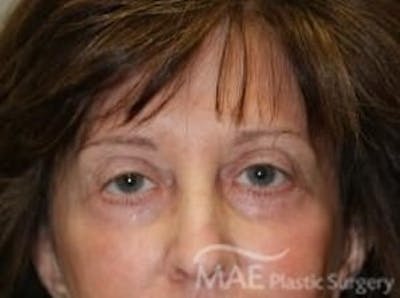 Eyelid Surgery Before & After Gallery - Patient 818769 - Image 2