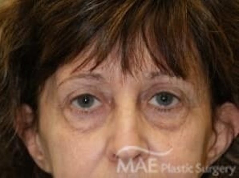 Eyelid Surgery Before & After Gallery - Patient 818769 - Image 1