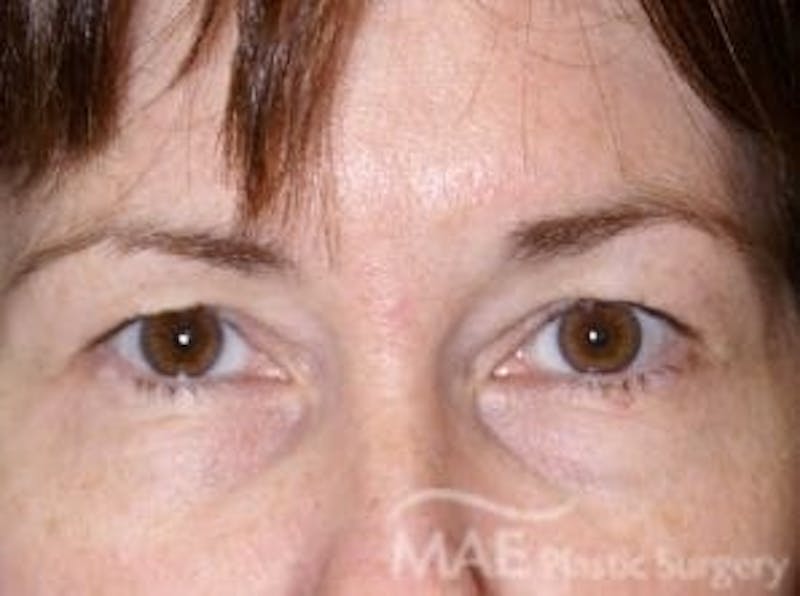 Eyelid Surgery Before & After Gallery - Patient 855996 - Image 1