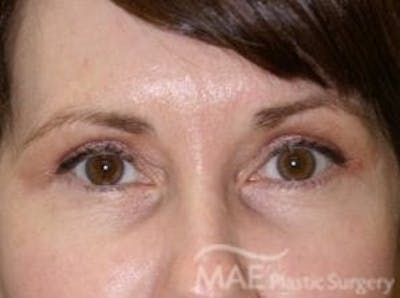 Eyelid Surgery Before & After Gallery - Patient 855996 - Image 2
