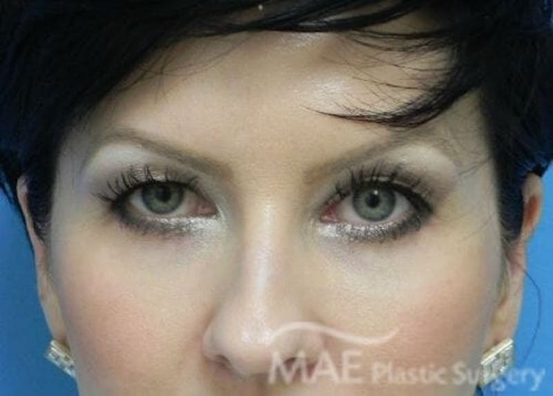 Eyelid Surgery Before & After Gallery - Patient 166061 - Image 1