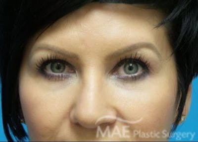Eyelid Surgery Before & After Gallery - Patient 166061 - Image 2
