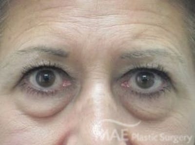 Eyelid Surgery Before & After Gallery - Patient 278372 - Image 1