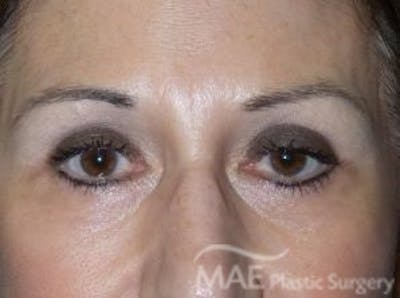 Eyelid Surgery Before & After Gallery - Patient 278372 - Image 2