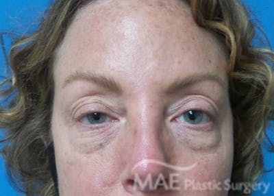Eyelid Surgery Before & After Gallery - Patient 172976 - Image 1