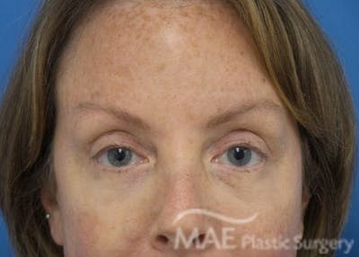 Eyelid Surgery Before & After Gallery - Patient 172976 - Image 2
