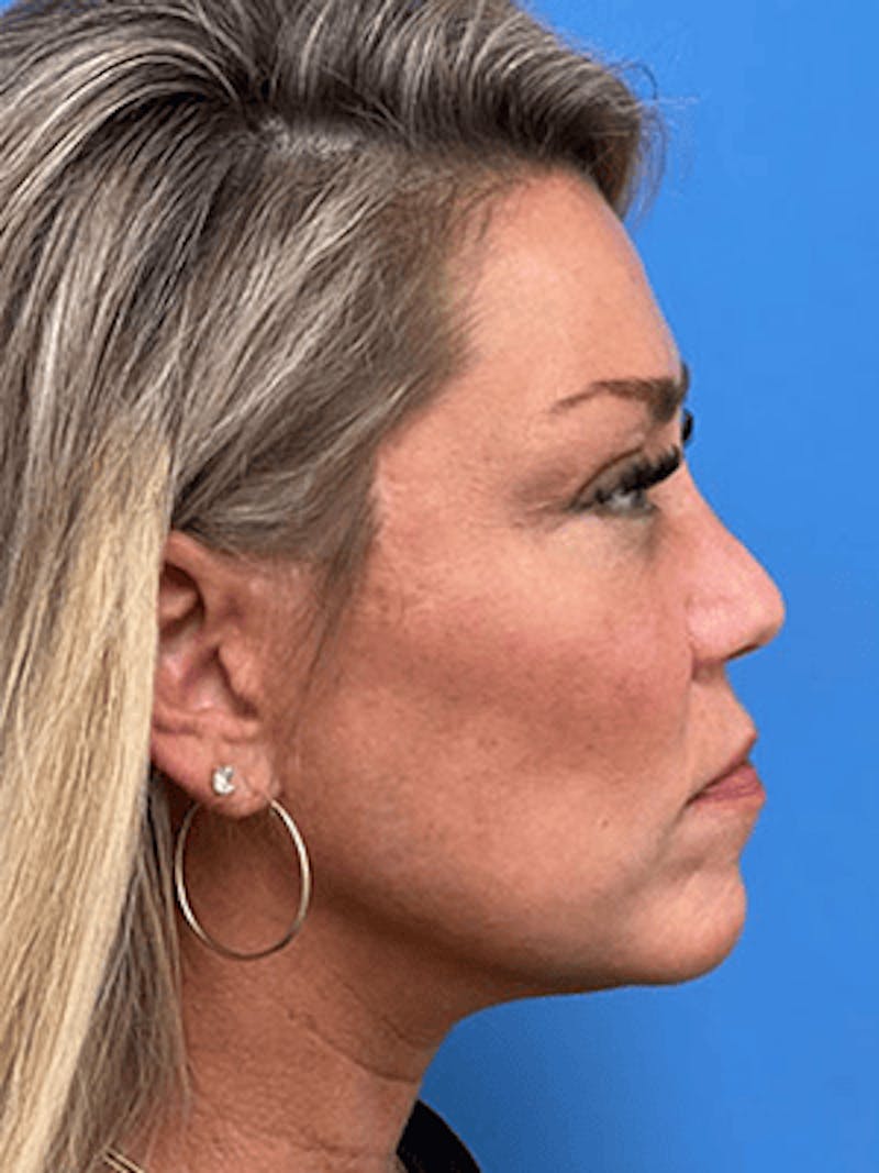 Facelift Before & After Gallery - Patient 328536 - Image 6