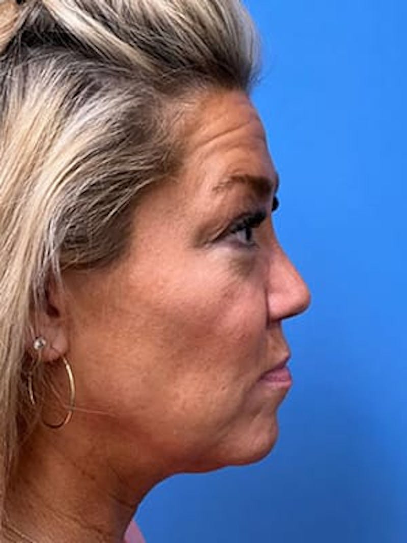 Facelift Before & After Gallery - Patient 328536 - Image 5