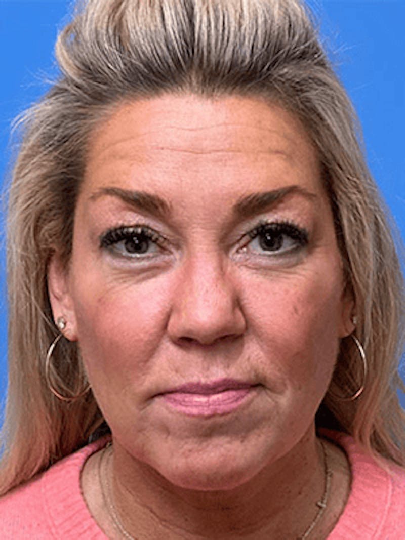 Facelift Before & After Gallery - Patient 328536 - Image 1
