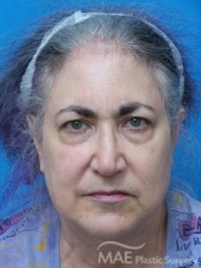 Facelift Before & After Gallery - Patient 206572 - Image 1