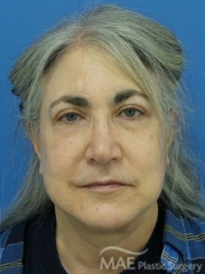 Facelift Before & After Gallery - Patient 206572 - Image 2