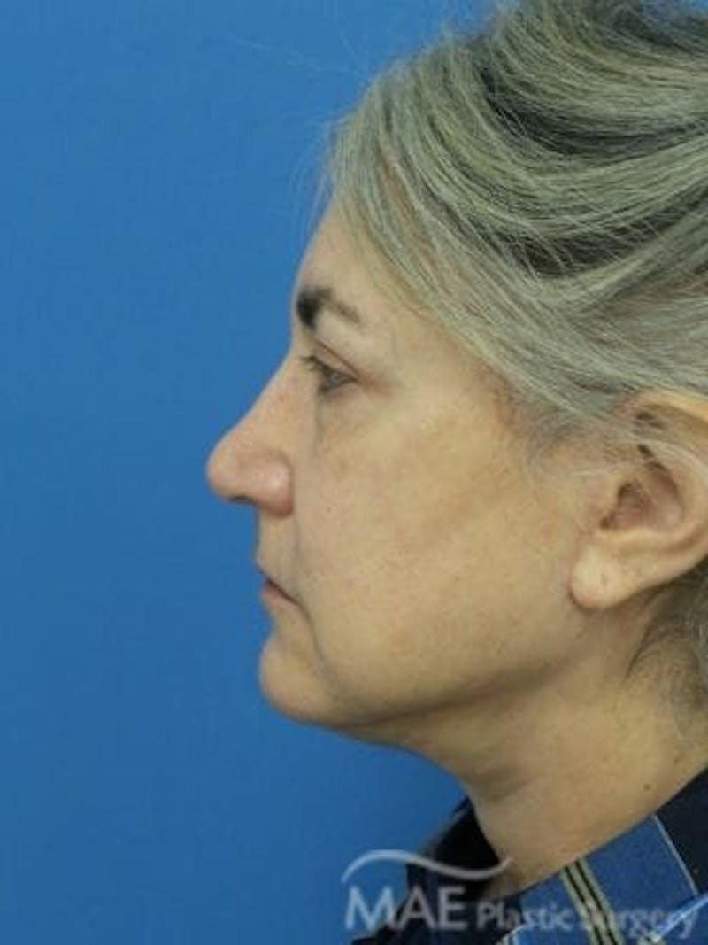 Facelift Before & After Gallery - Patient 206572 - Image 6