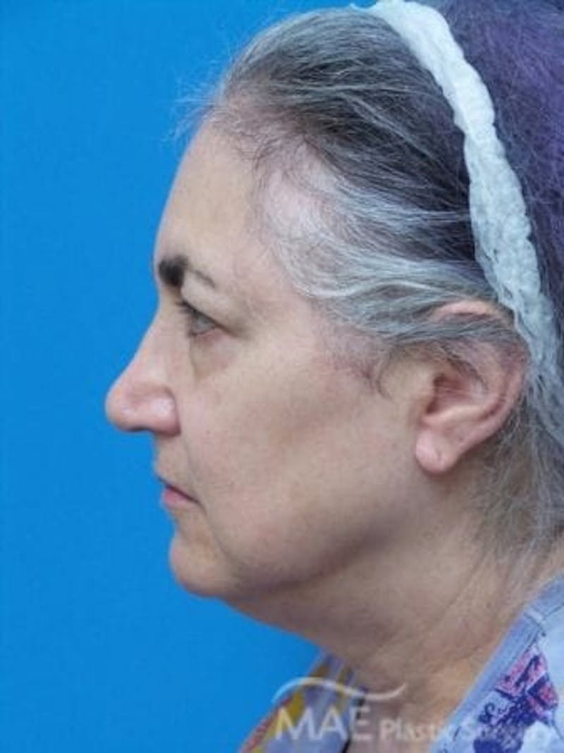 Facelift Before & After Gallery - Patient 206572 - Image 5