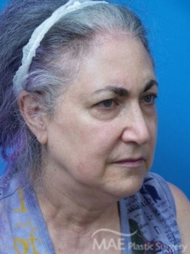 Facelift Before & After Gallery - Patient 206572 - Image 3