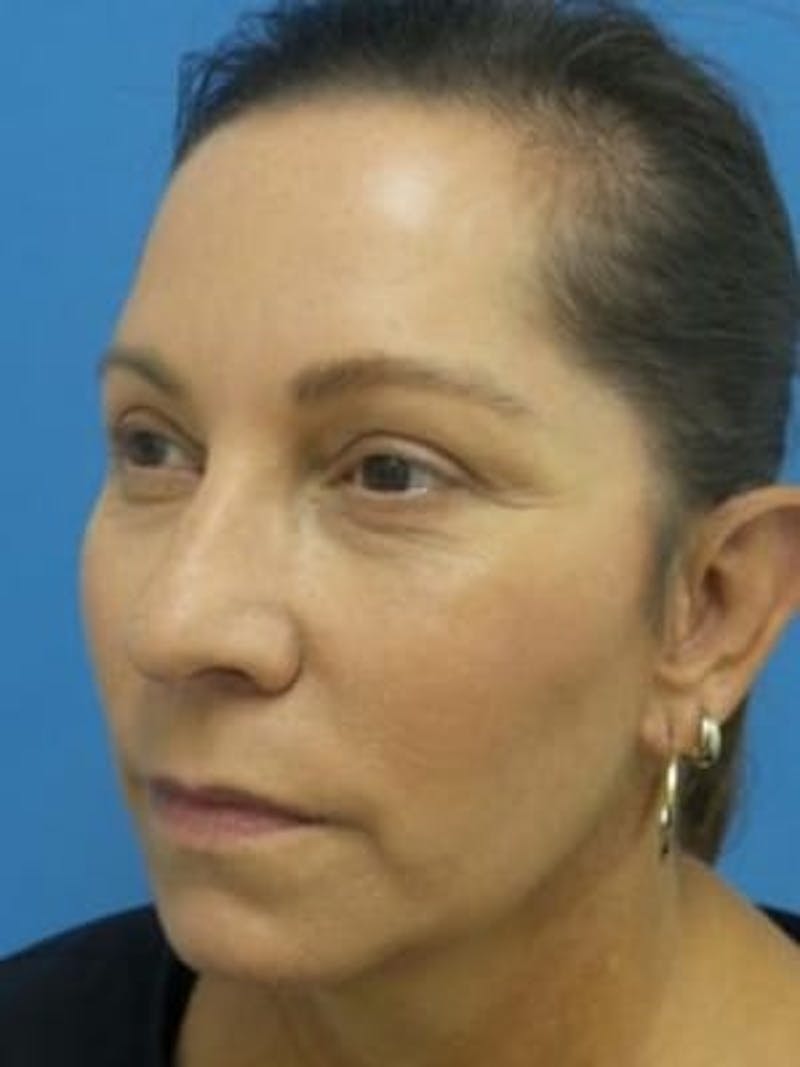 Facelift Before & After Gallery - Patient 357696 - Image 4