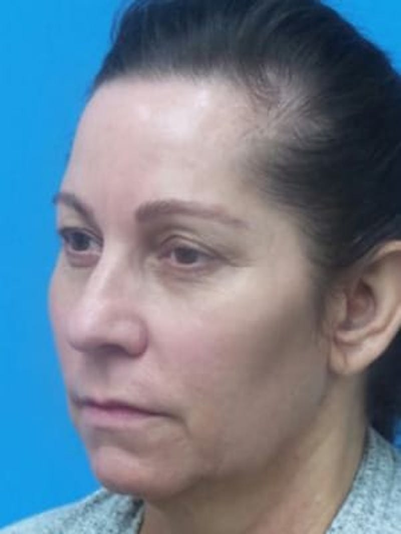Facelift Before & After Gallery - Patient 357696 - Image 3