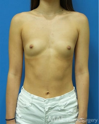 Breast Lift Before & After Gallery - Patient 379124 - Image 1
