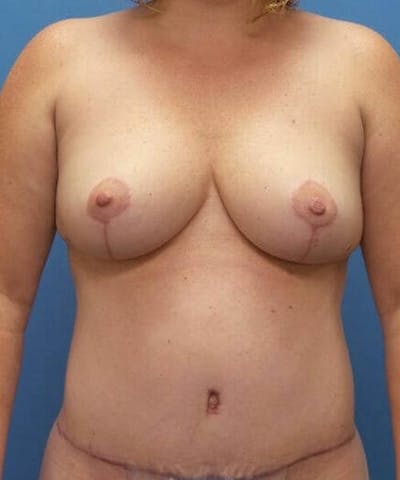 Breast Reduction Before & After Gallery - Patient 312310 - Image 2