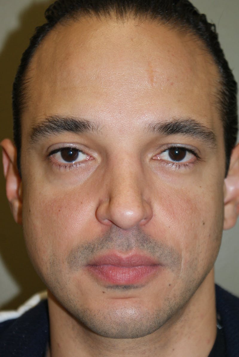 Rhinoplasty Before & After Gallery - Patient 235451 - Image 4