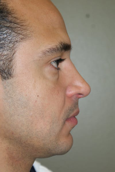 Rhinoplasty Before & After Gallery - Patient 235451 - Image 2