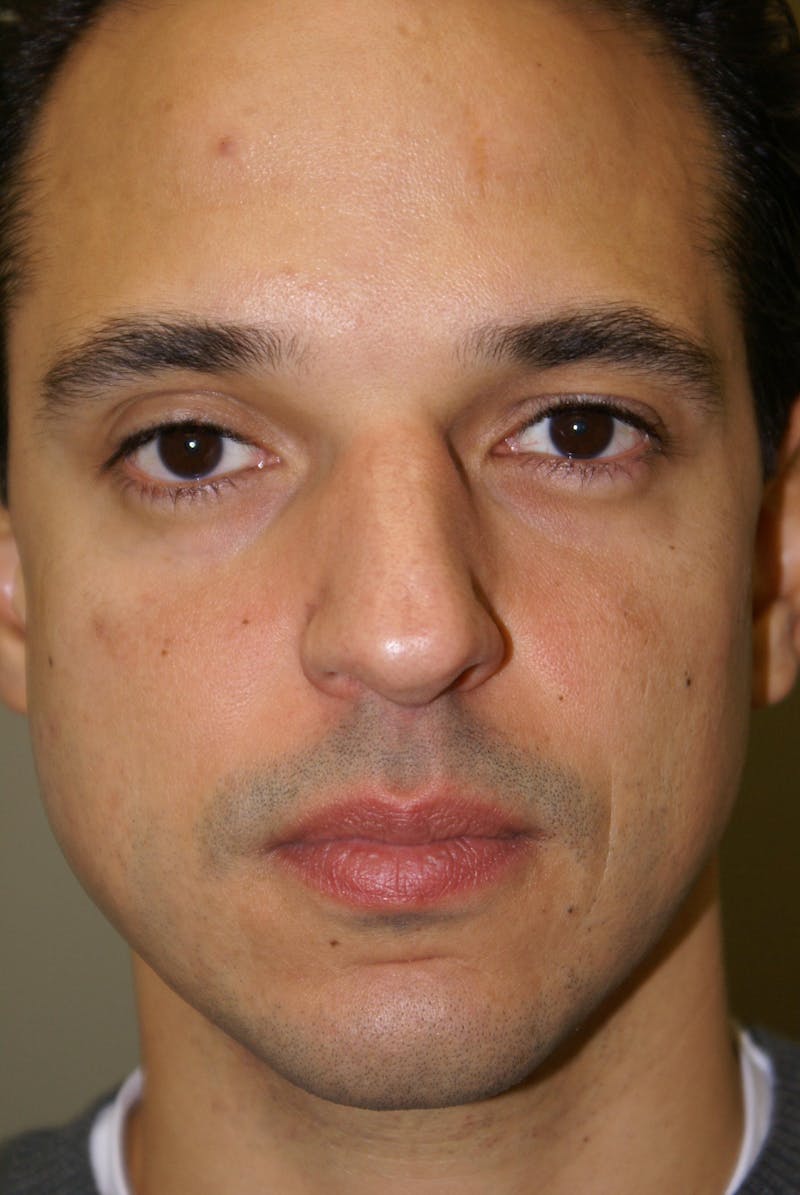 Rhinoplasty Before & After Gallery - Patient 235451 - Image 3