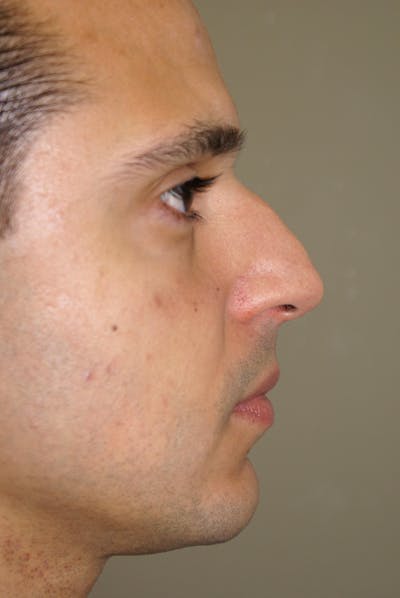Rhinoplasty Before & After Gallery - Patient 235451 - Image 1