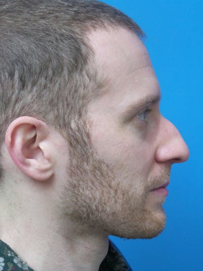 Rhinoplasty Before & After Gallery - Patient 276987 - Image 1